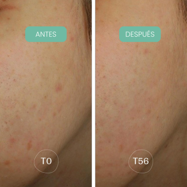 Piel con manchas visiblemente reducidas después de usar Sérum Facial antimanchas Alga-Biotic Laboratoires de Biarritz