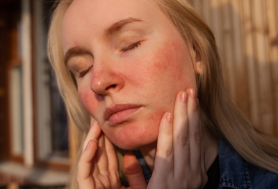 Rosácea: cómo cuidar la piel sensible y protegerla del sol con cosmética natural